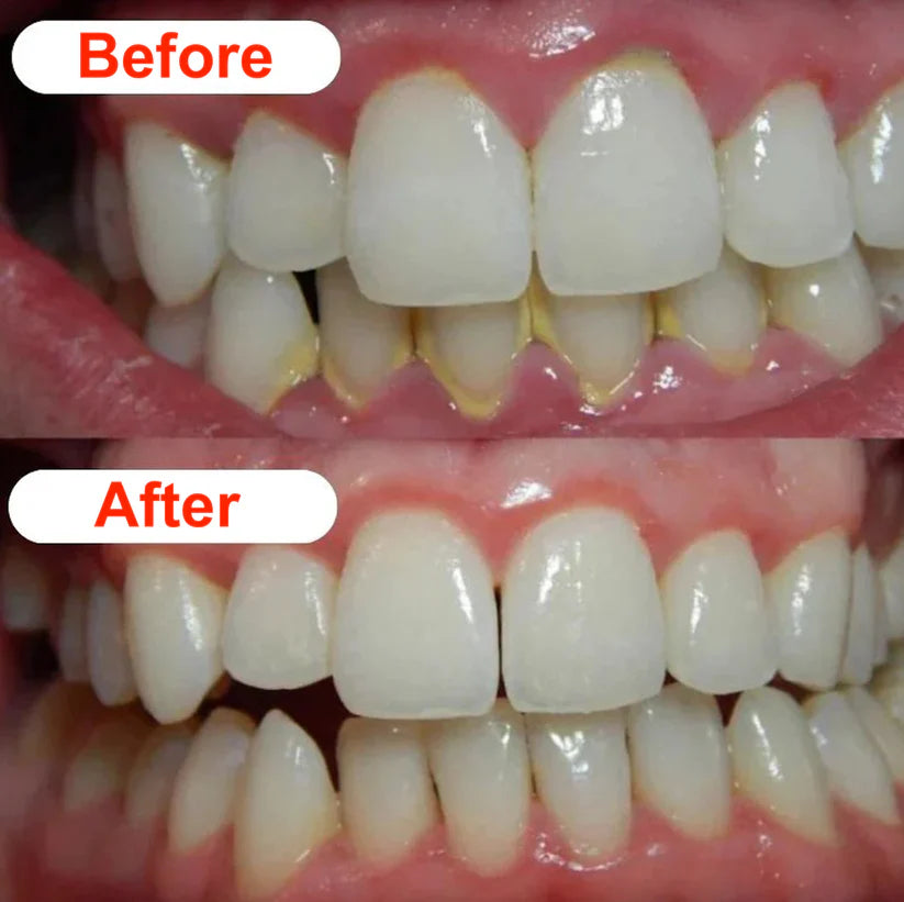 Dental Scaler
